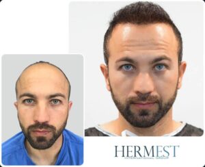 Hermest Hair Transplant