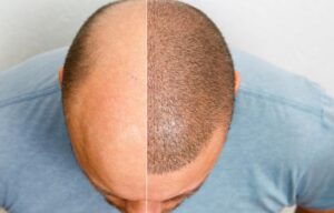 Données statistiques sur la greffe de cheveux